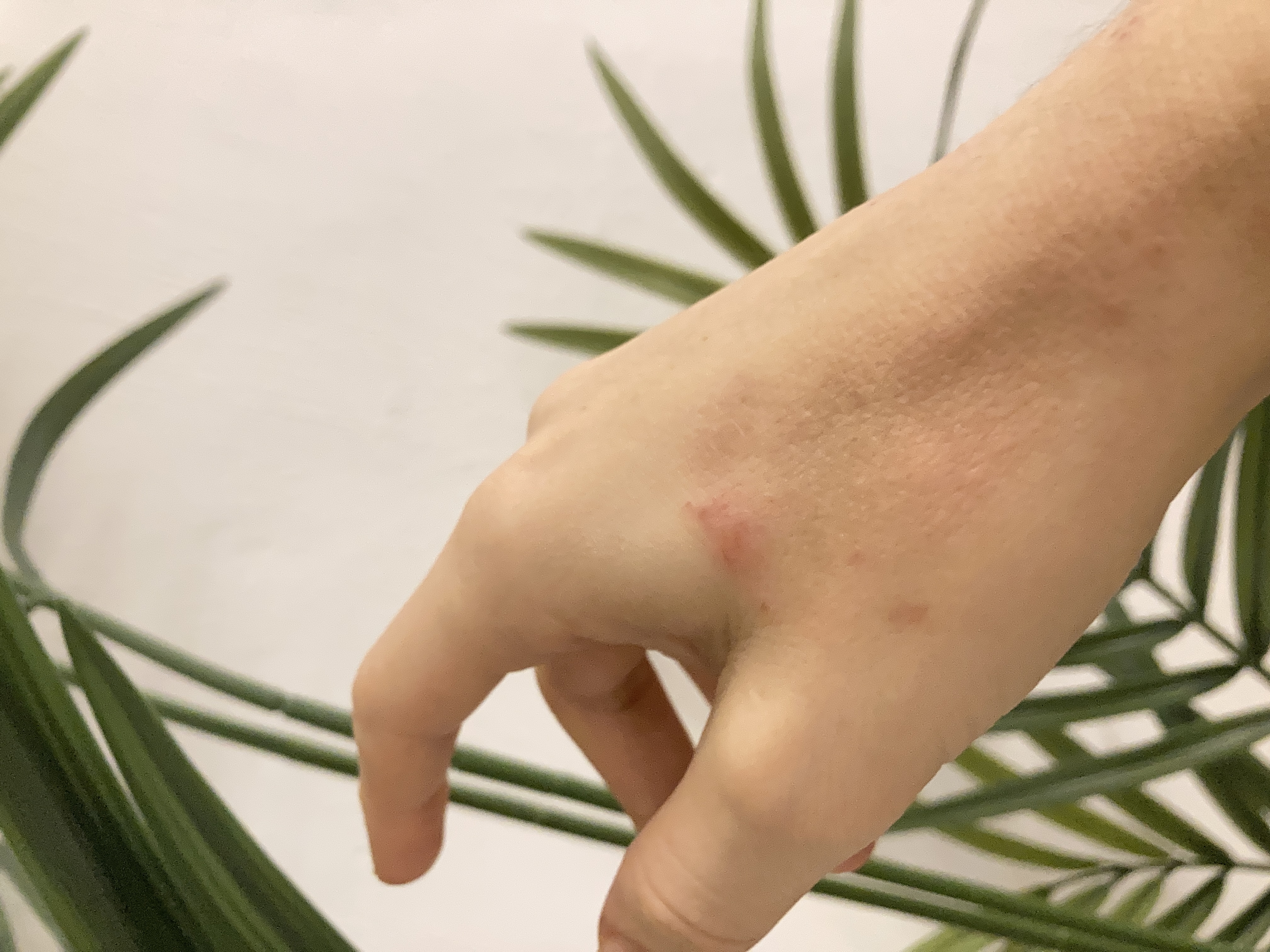 Neue Therapien bei Neurodermitis